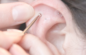 Acupuncture auriculaire